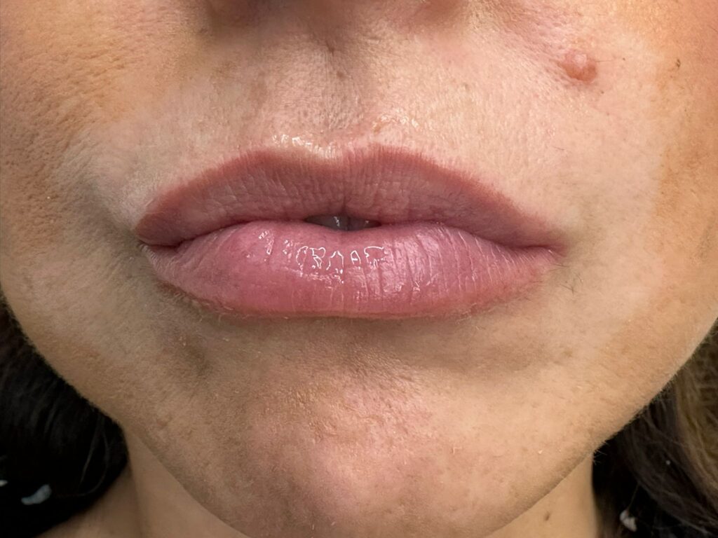 resultados dermapen