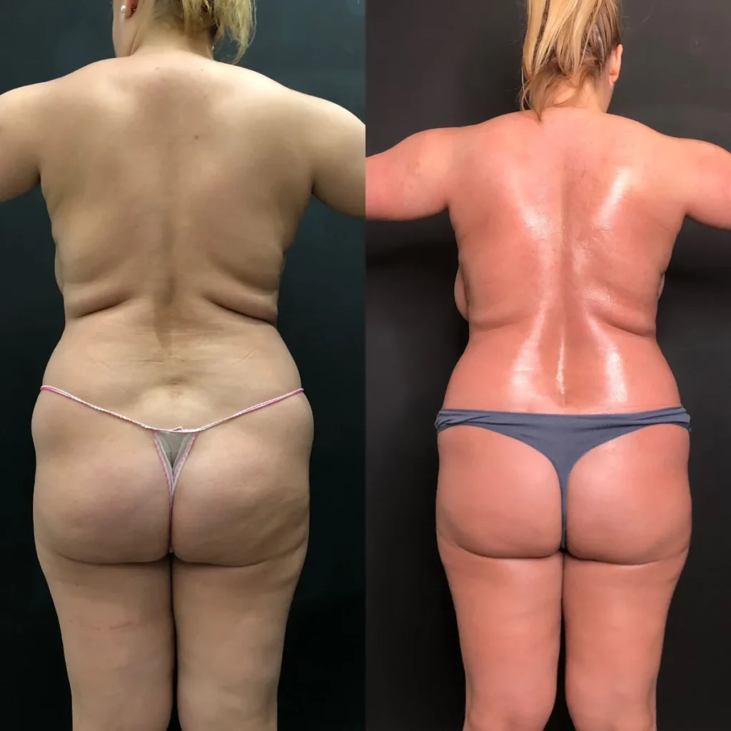 Antes y después de una sesión de Bioslimming en Bonita Mía Beauty, Zaragoza